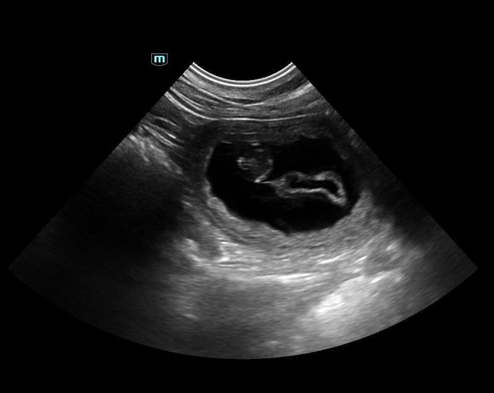Procaine portée vers le 5 Janvier 2026